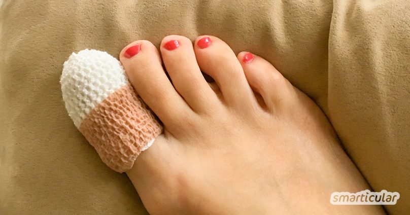 Nagelpilz lässt man besser vom Arzt behandeln. Gegen Nagelpilz und Fußpilz vorbeugen kann man aber bestens mit Hausmitteln!