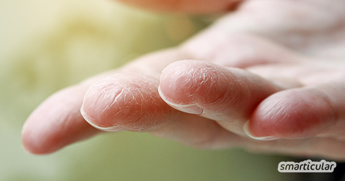 Trockene, rissige Hände werden dank sanfter Pflege mit natürlichen Wirkstoffen wieder weich und geschmeidig.