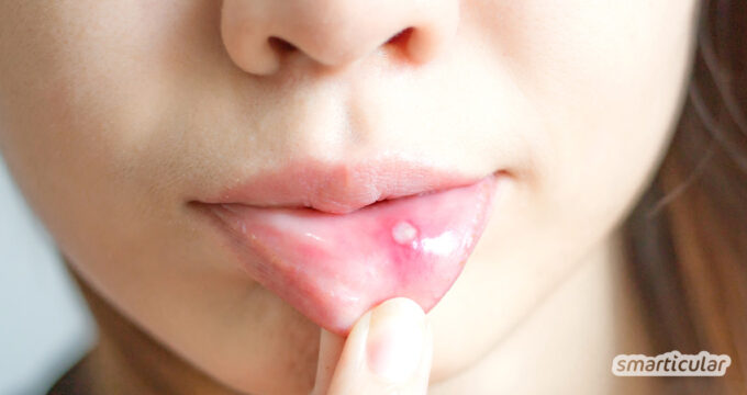Aphthen im Mund sind unangenehm und können schmerzhaft sein. Lies hier, wie du Aphthen mit Hausmitteln schneller verschwinden lassen kannst.